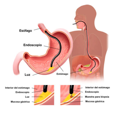 Endoscopia de Vías Digestivas Altas Cigeo