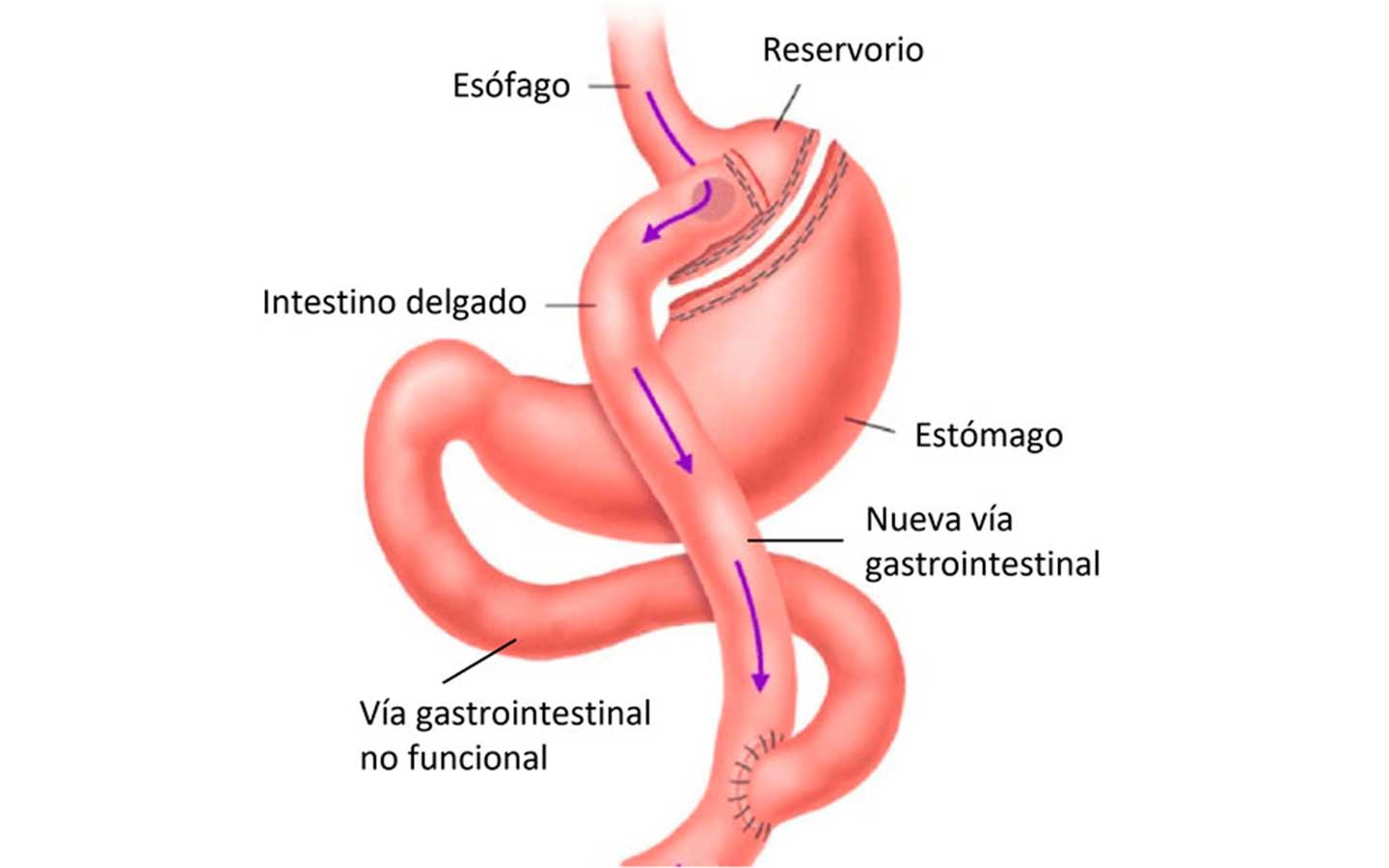 bypass gástrico y de roux
