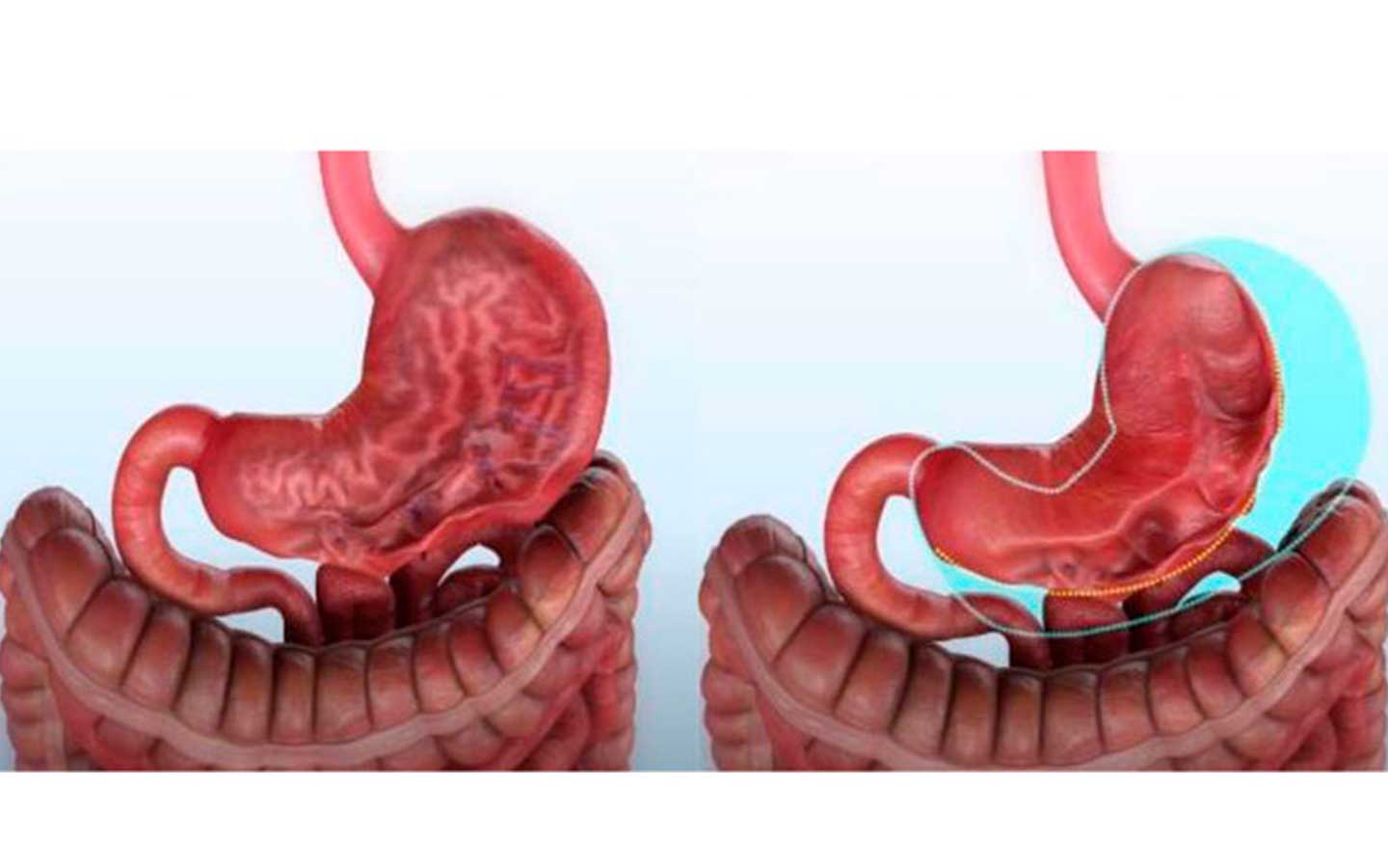 sutura del estómago en manga gástrica