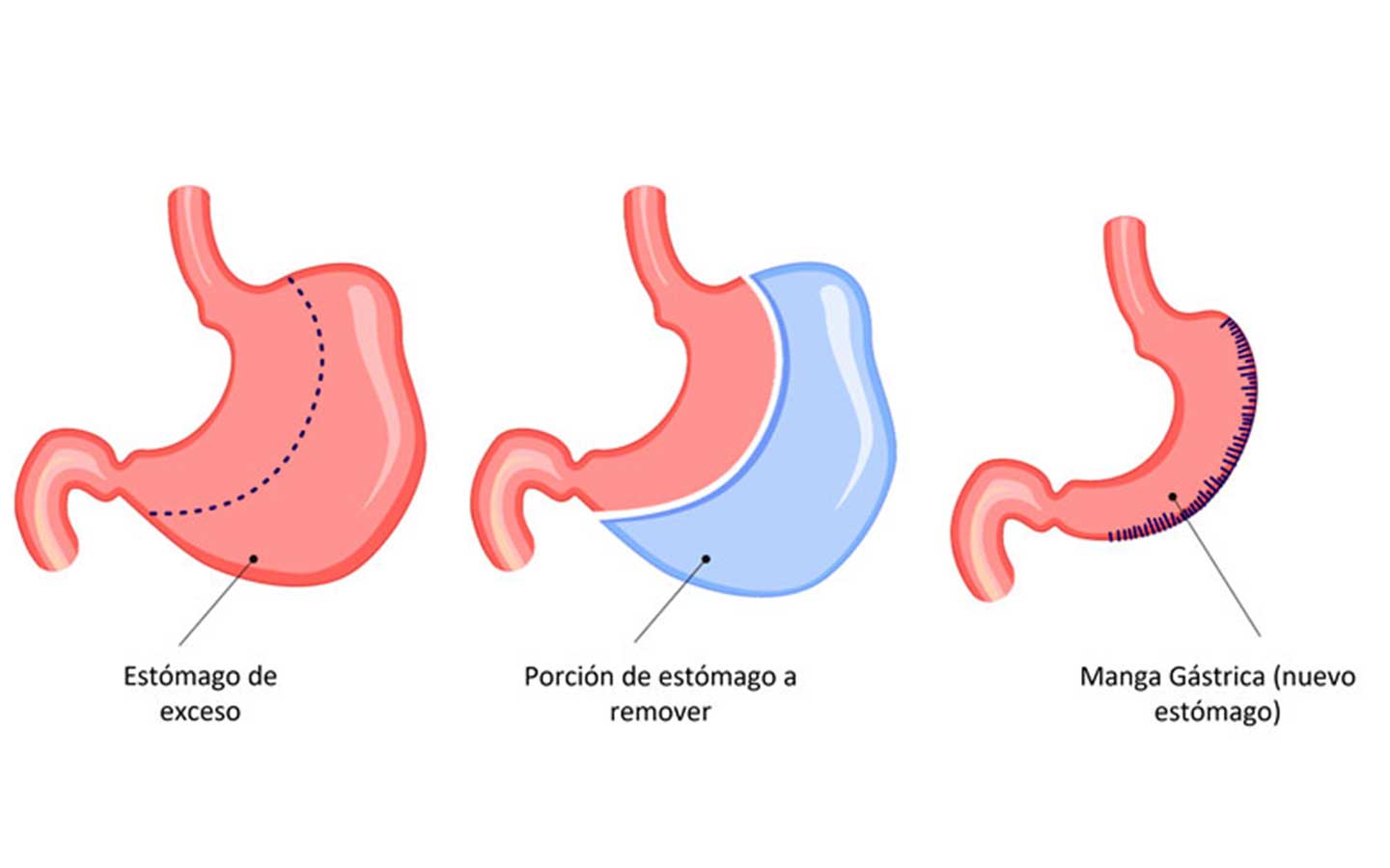 esquema de manga gástrica