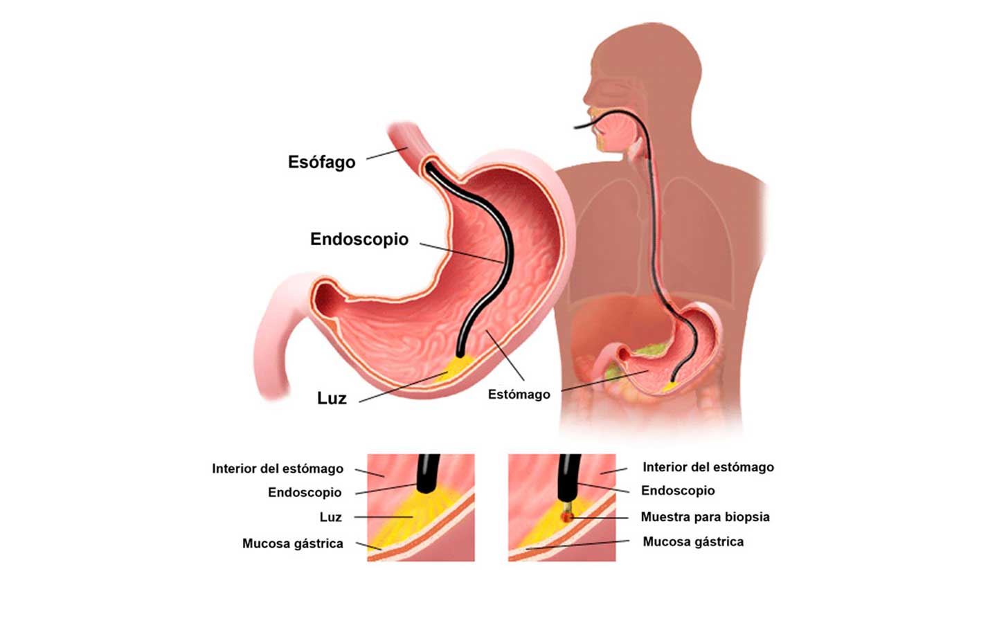 endoscopia de vias digestivas