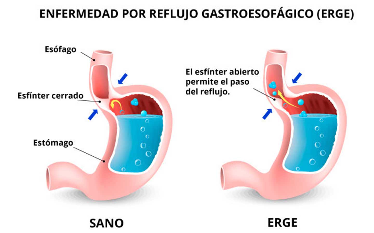 enfermedad reflujo gástrico