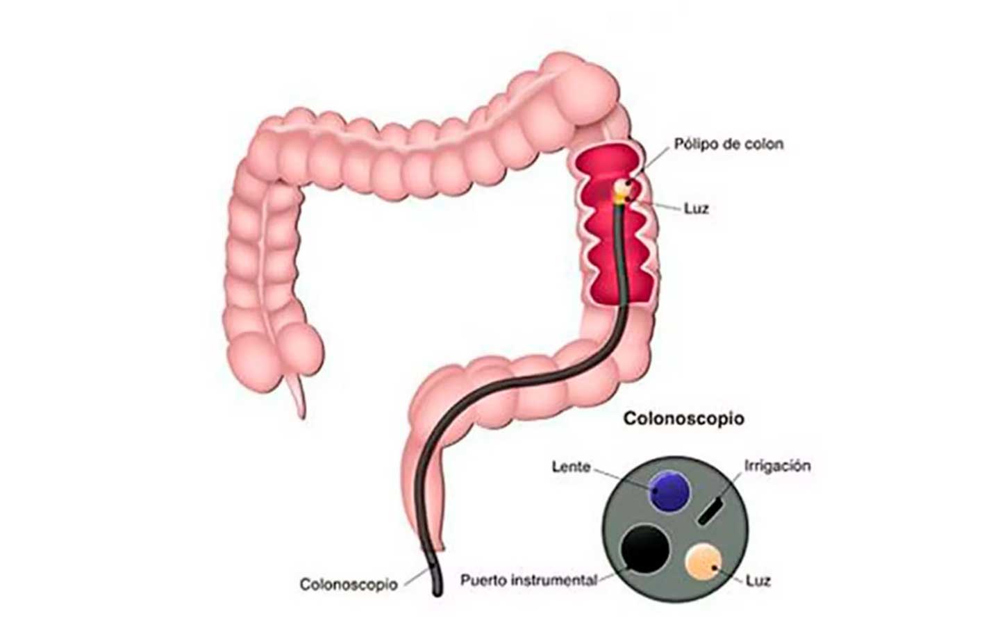 diagnóstico cáncer colon por colonoscopia